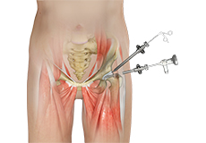 Hip arthroscopy