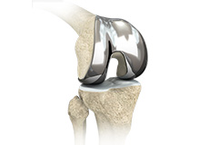 Custom Knee Replacement