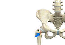 Femoral Neck Fracture