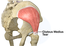 Gluteus Medius Tear