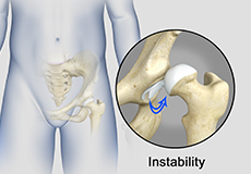 Hip Instability