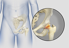 Hip Synovitis