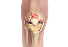 Knee Osteoarthritis