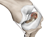 Meniscal Surgery