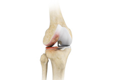 Non-Surgical Knee Treatments 