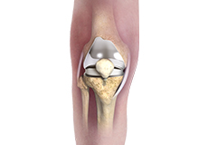 Patient Specific Knee Replacement