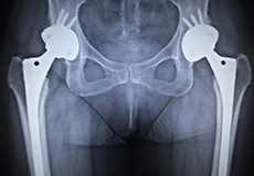 X-ray Guided Hip Replacement